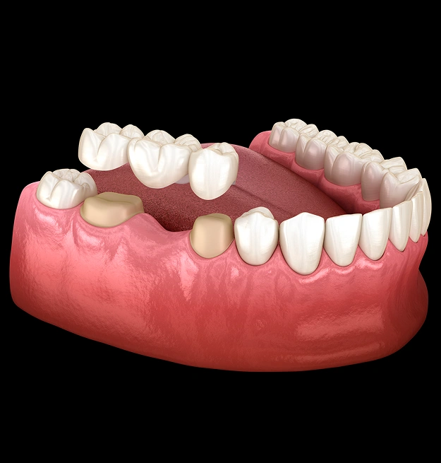 Close up of a dental model showing a pink gum base with multiple white dental crowns and bridges