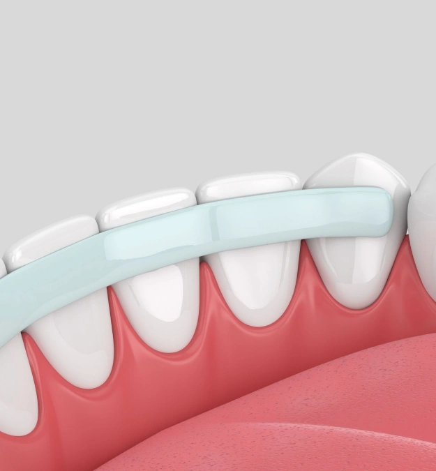 Dental bonding procedure illustration showing tooth restoration at Polished Smiles of Round Rock in Round Rock TX