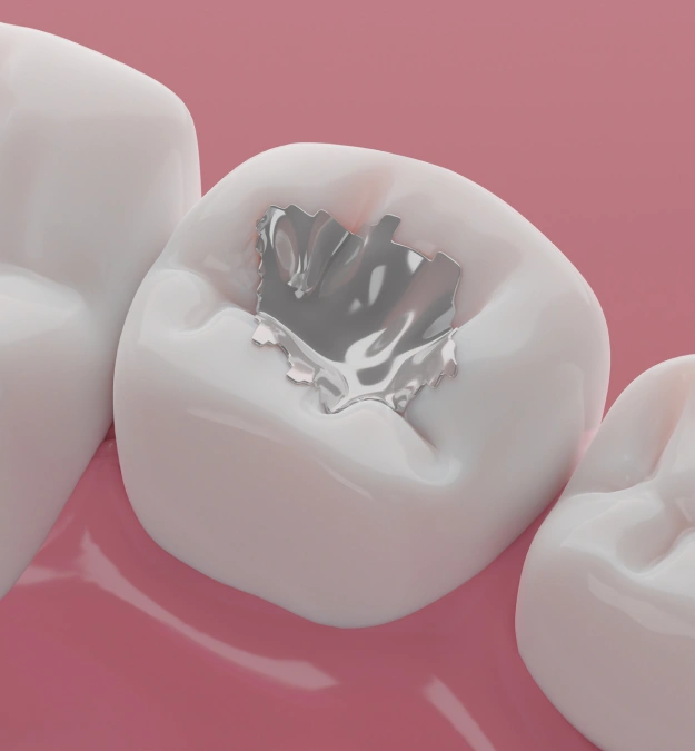 Close up 3D illustration of a tooth with a silver dental filling on a pink background