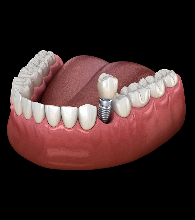 3D illustration of a dental implant inserted into a pink gum model showing the lower jaw
