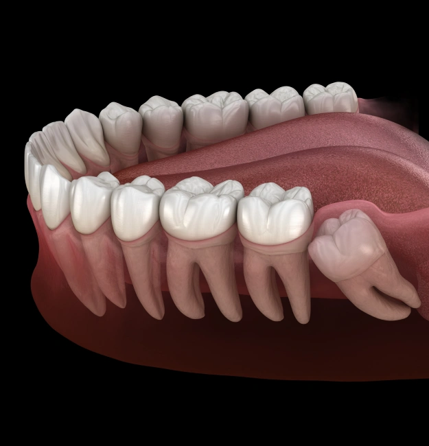 3D illustration of a lower jaw dental model showing wisdom teeth and surrounding molars